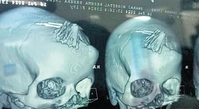 சூனியக்காரரால் பெண்ணின் தலையில் செலுத்தப்பட்ட 77 ஊசிகள்: அகற்றிய மருத்துவர்கள்!